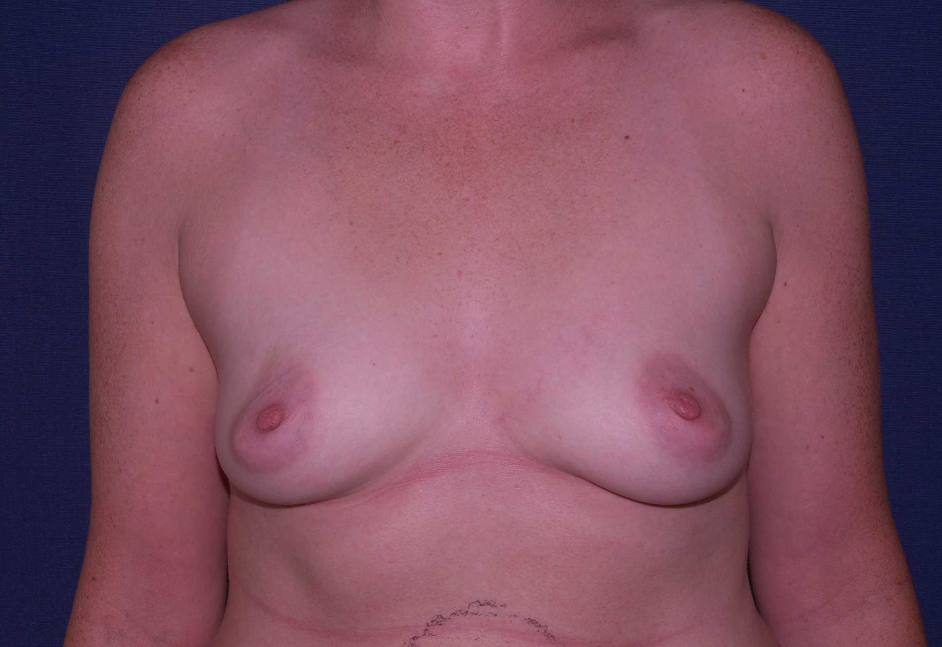 Best Boca Raton Breast Augmentation