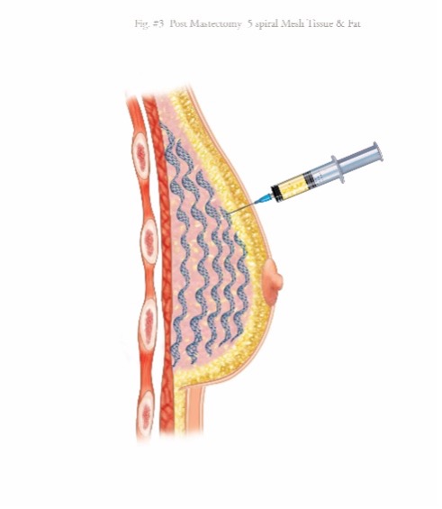 Graphic of Fat Being Injected Into Mesh