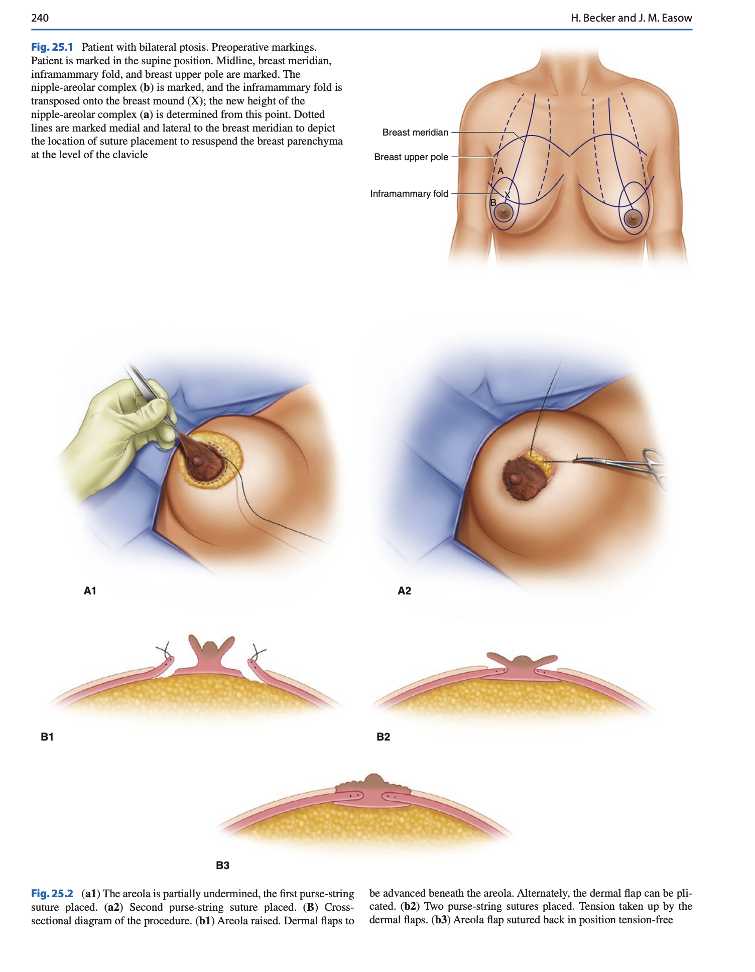 Minimizing Scars in Mastopexy chapter page