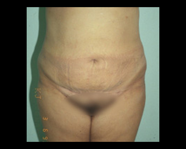 Liposuction Lipoplasty Before & After | Dr. Becker
