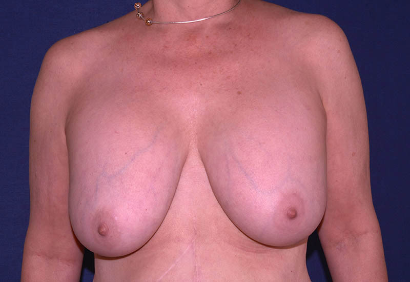 Breast Implant Removal Boca Raton