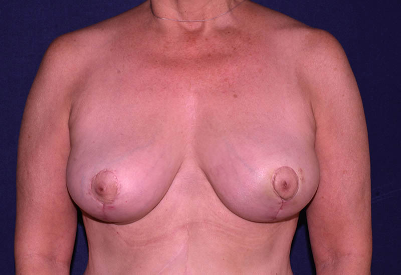 Breast Implant Removal Boca Raton