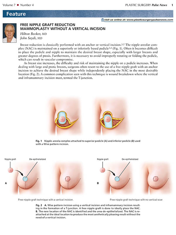 Breast Reconstruction Using Mesh Support