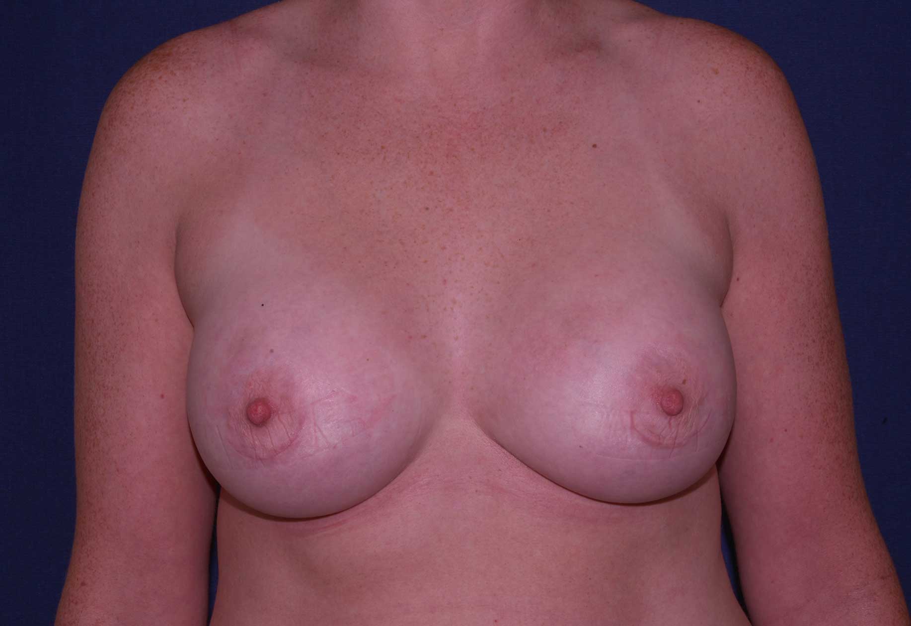 Breast Augmentation Boca Raton